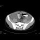 Gelatinous tumor spread in the abdominal cavity: CT - Computed tomography